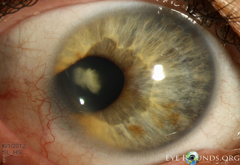 Temporal iris and lens coloboma associated with cataract