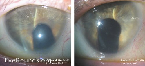 Temporal iris and lens coloboma associated with cataract