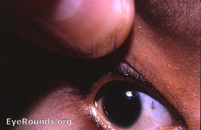 cogential iris coloboma with pyriform cornea