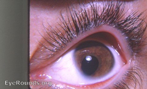 coloboma of the eye