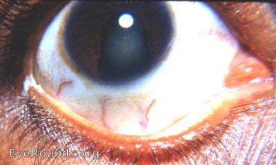 cogential or surfical coloboma