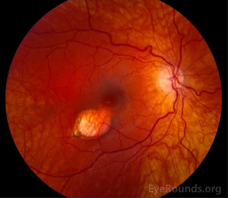 OCT torpedo maculopathy