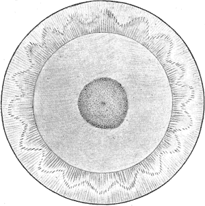 Drawing illustrating a Coppock Cataract