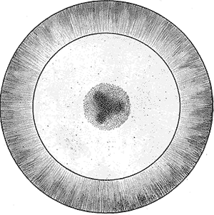 diagram of atypical Coppock Cataract