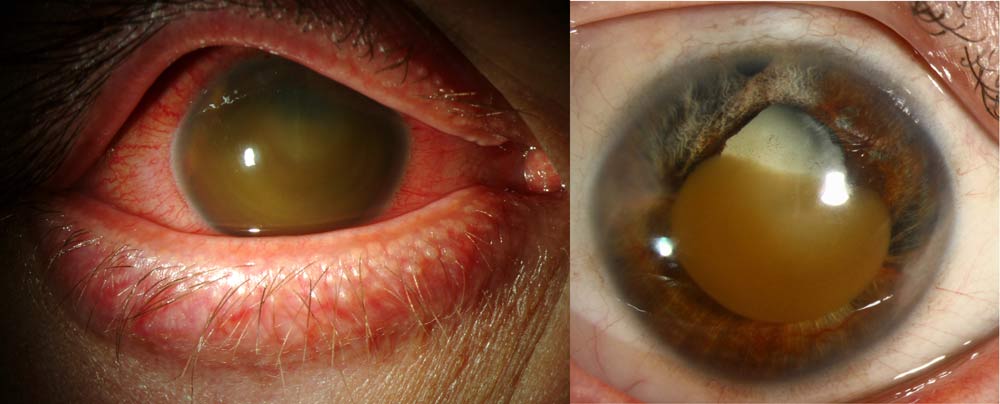 Corneal blood staining typically occurs after significant and prolonged hyphema