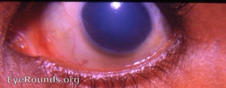 Cornea: familial dystrophy of the cornea with initial epithelial edema followed years later by fatty infiltration 2
