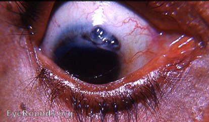 post-op cataract complications
