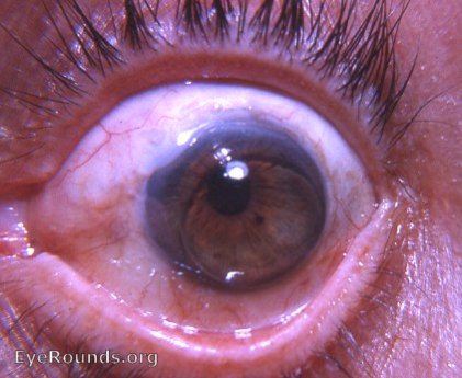 Intracapsular cataract extraction with cystoid cictrix and a corneal contact lens