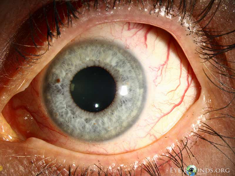 full dilated eye showing hypertension