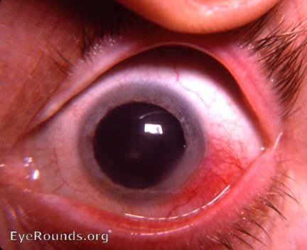 episcleritis with keratitis