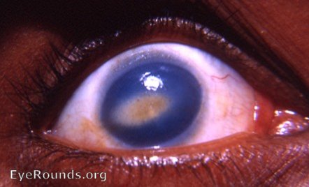 familial corneal dystrophy