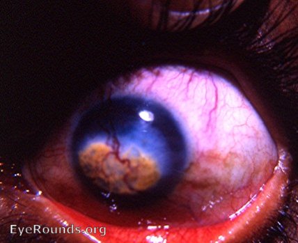 fatty degeneration of the cornea