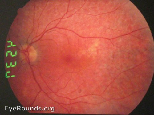 Fundus Pisciform flecks in the retina