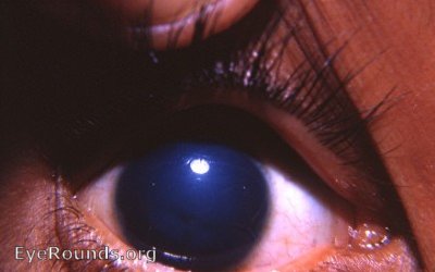 Cornea: familial dystrophy of the cornea with initial epithelial edema followed years later by fatty infiltration 2
