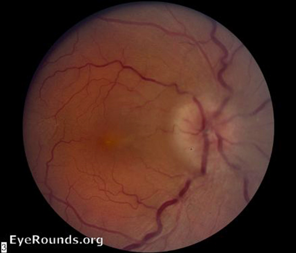 Neuroretinitis