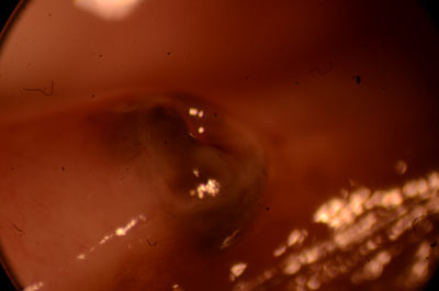 Intradermal Nevus, combined type with mild atypia