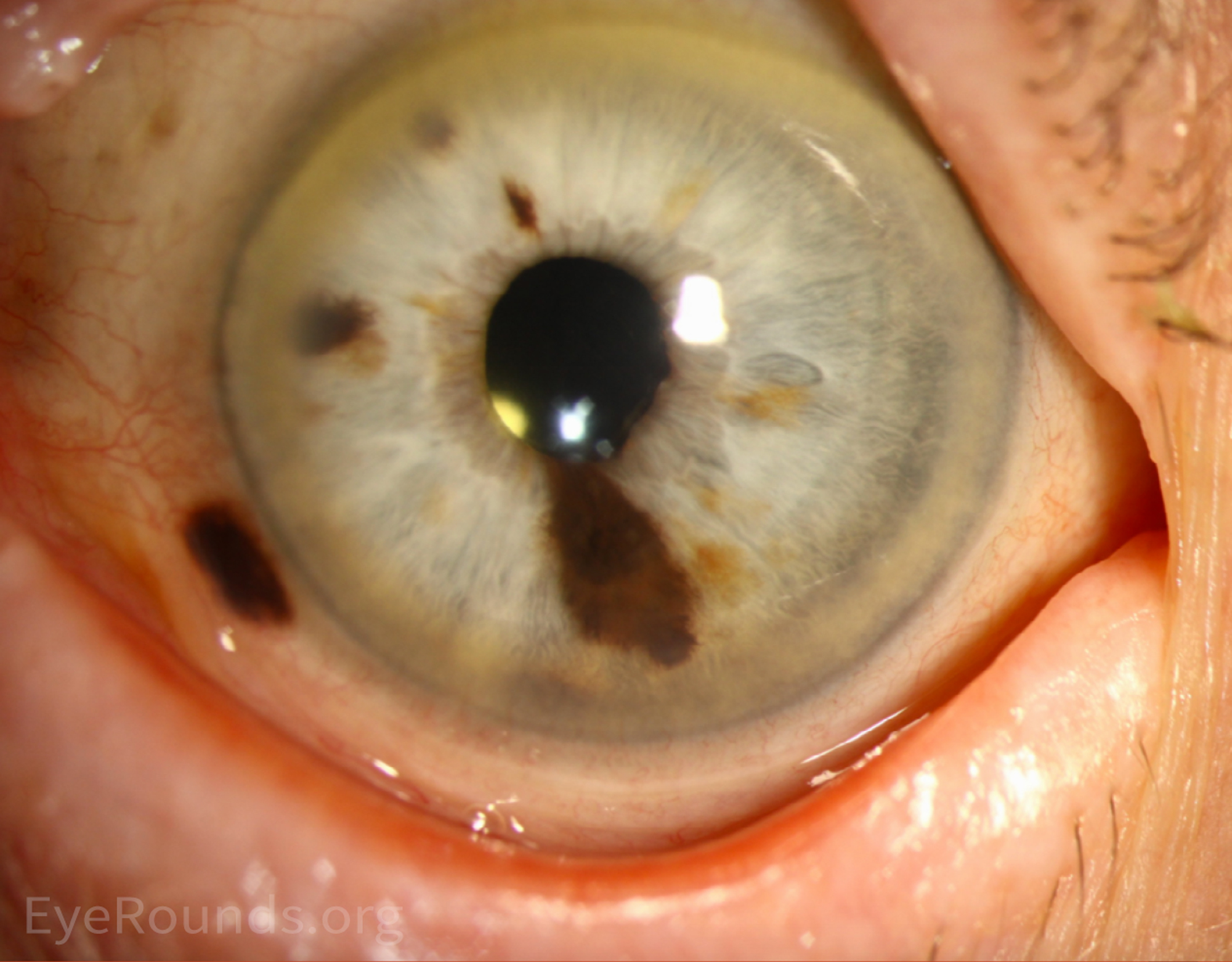 Iris Melanoma lower portion of eye and left side