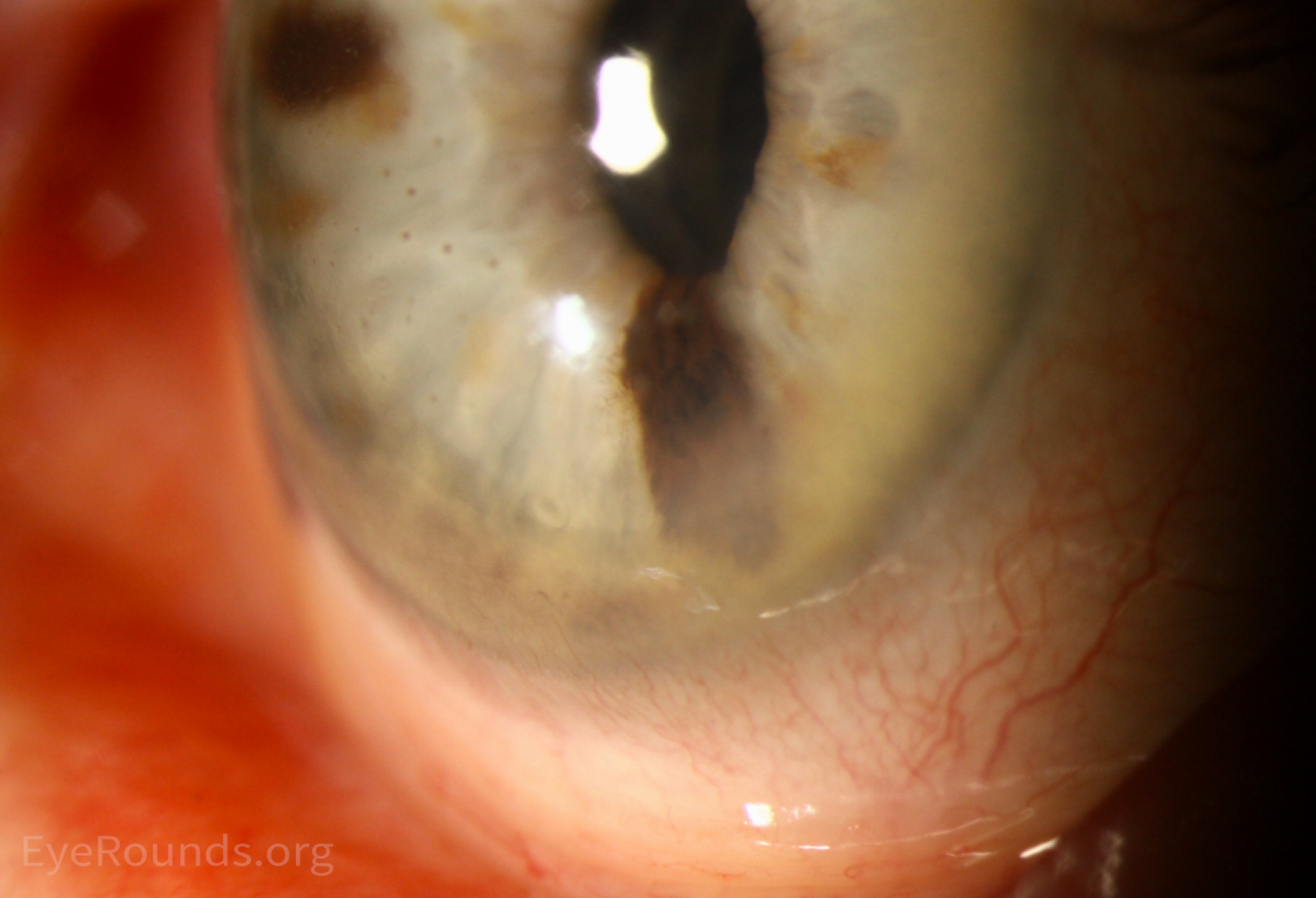 Pigmented keratic precipitates on the corneal endothelium