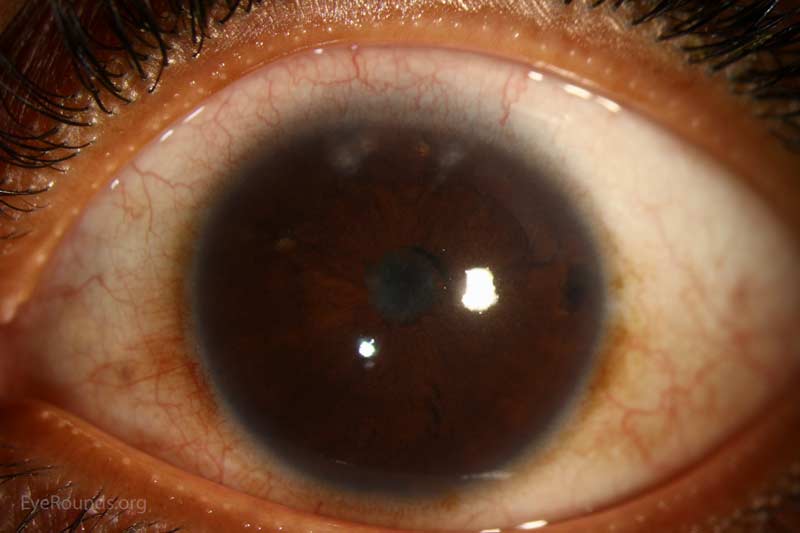  iris bombe developed in this patient with chronic iridocyclitis and central posterior synechiae.