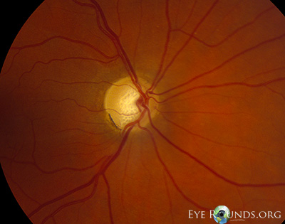 whole fundus shwoing deep optic nerve head cup and prominent inferotemporal notch secondary to optic nerve damage from primary open angle glaucoma