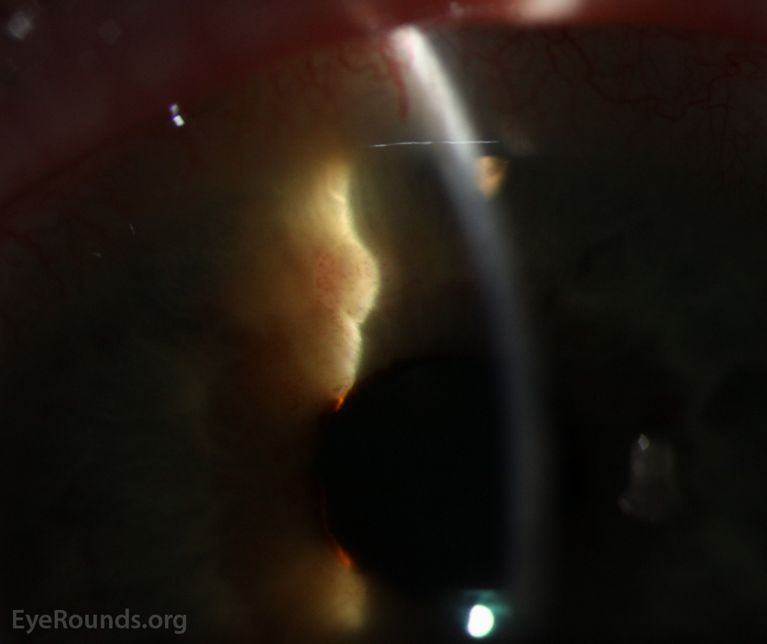 presence of gelatinous fibrovascular lesions along the pupillary margin and peripheral iris
