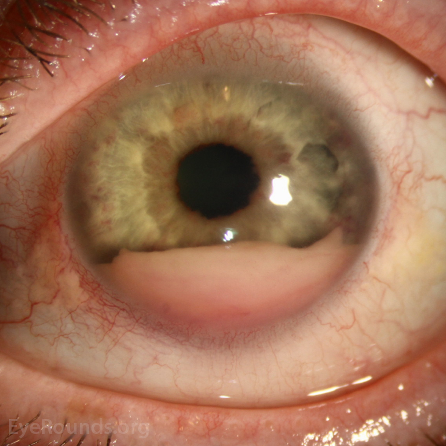  Slit lamp photograph of the left eye shows mild injection, clear cornea, and presence of a 3.5 mm blood-tinged pseudohypopyon in the anterior chamber