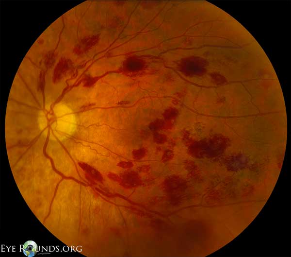 many central and paracentral superficial hemorrhages- fundus