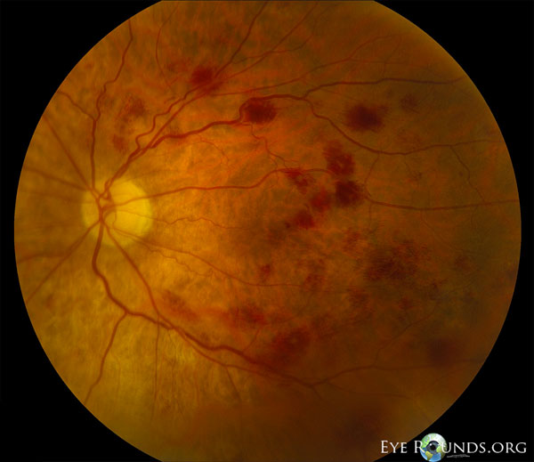  fundus after chemotherapy, and her follow-up fundus photos are shown below 2
