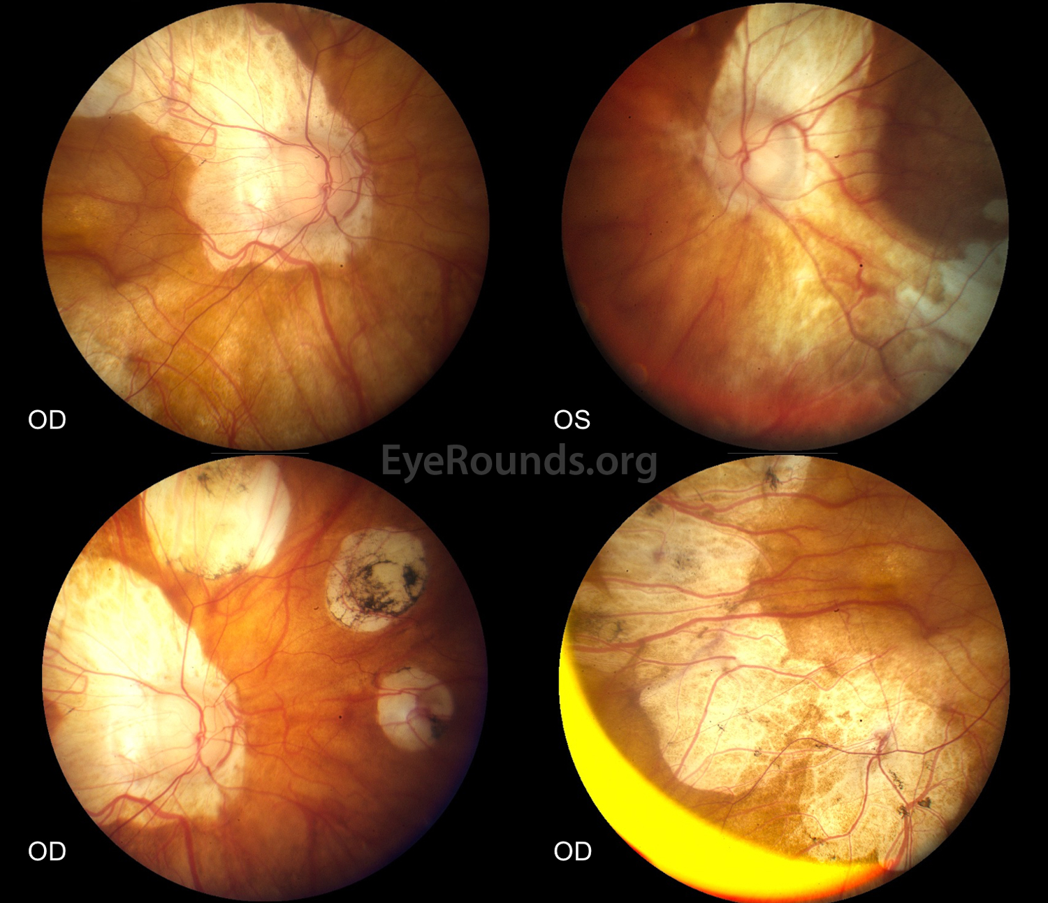 4 fundus photos showing marshall syndrome