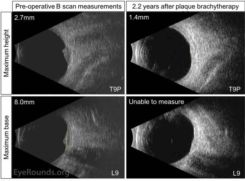 Echography of the left eye pre-operatively (left images) and two years after plaque brachytherapy (right images). The upper images are transverse images centered on 9 o'clock posteriorly (T9P), and the lower images are longitudinal images centered on 9 o'clock (L9). Left images: The pre-operative maximum elevation of the choroidal lesion was 2.7 mm, and the pre-operative base of the choroidal lesion measured 8.0 mm. Right images: 2.2 years after plaque radiation therapy, the maximum choroidal lesion height was 1.4 mm with evidence of involution. The tumor base was unable to be measured by echography. 