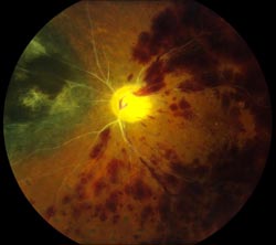 Central retinal vein and artery occlusions in proliferative radiation retinopathy