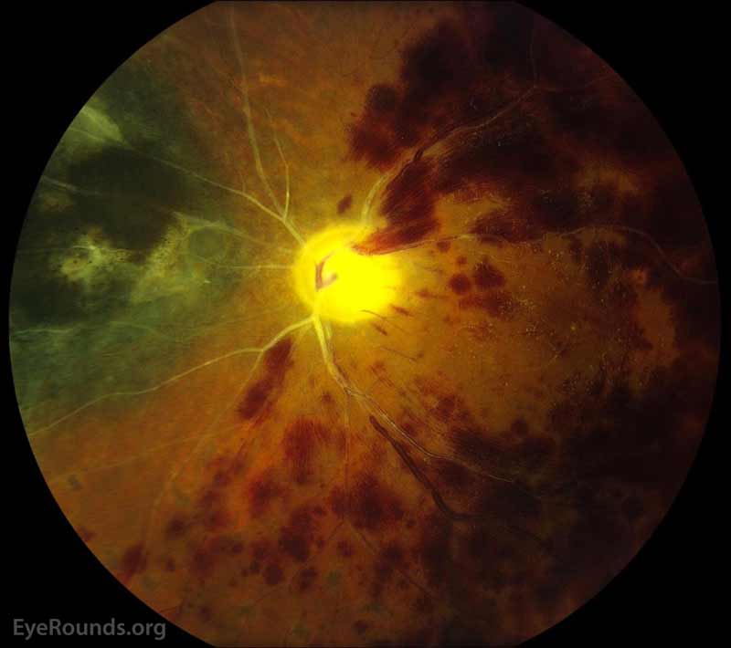 Color fundus photographs, left eye, 5 weeks after combined CRAO/CRVO. Nasal to the optic nerve, there was a 9 x 7.0 x 1.5 mm elevated, moderately pigmented choroidal lesion with overlying coarse pigmentary changes and drusen. There were panretinal photocoagulation scars in the nasal and superior periphery with persistent, extensive retinal hemorrhages throughout the macula and in the mid-periphery superiorly, temporally, and inferiorly. There was severe, diffuse disc pallor OS with peripapillary hemorrhages temporally and severely sclerotic vessels.