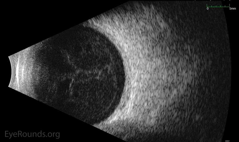 The B-scan ultrasound (bottom) demonstrates a vitreous hemorrhage without a retinal detachment.