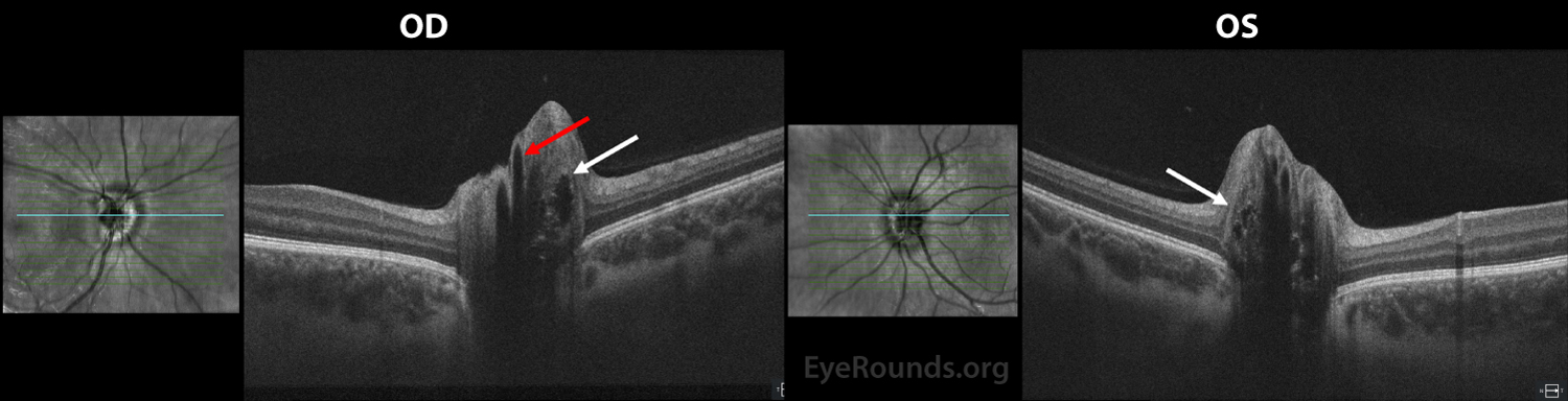 Optic Disc Drusen Online Ophthalmic Atlas