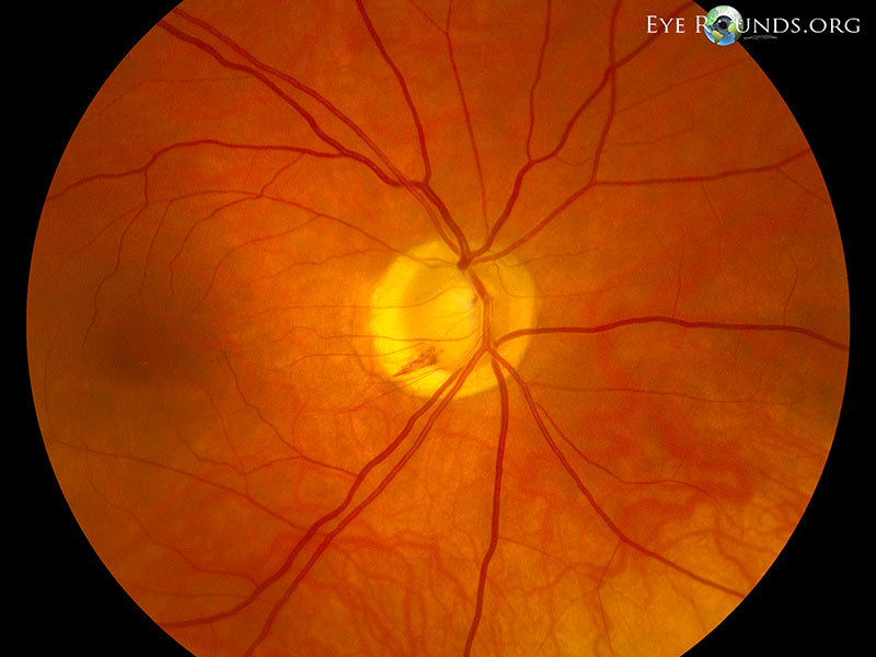 Optic disc hemorrahge in normal tension glaucoma