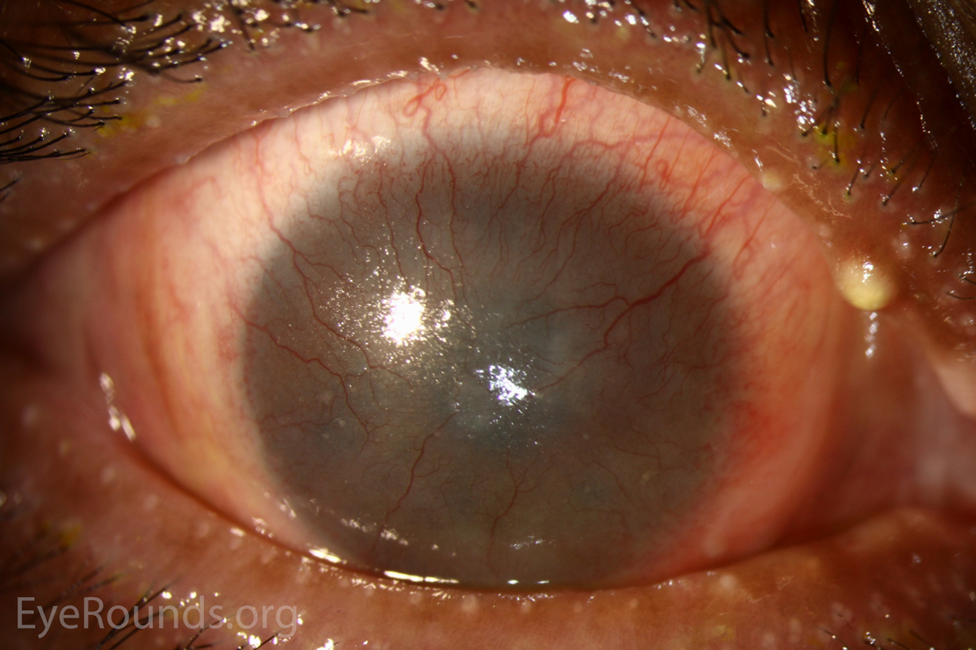 Corneal pannus is subepithelial fibrovascular tissue ingrowth from the limbus onto the cornea