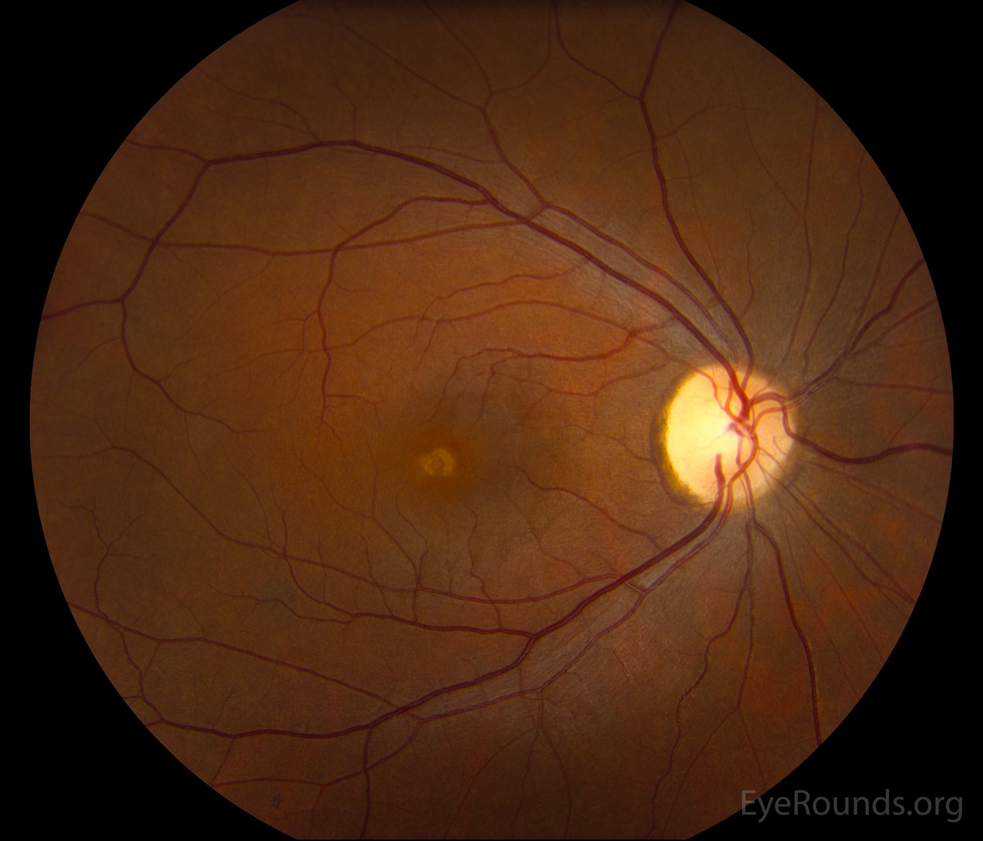 fundus montage OD 42-year-old female with molecularly-proven pattern dystrophy
