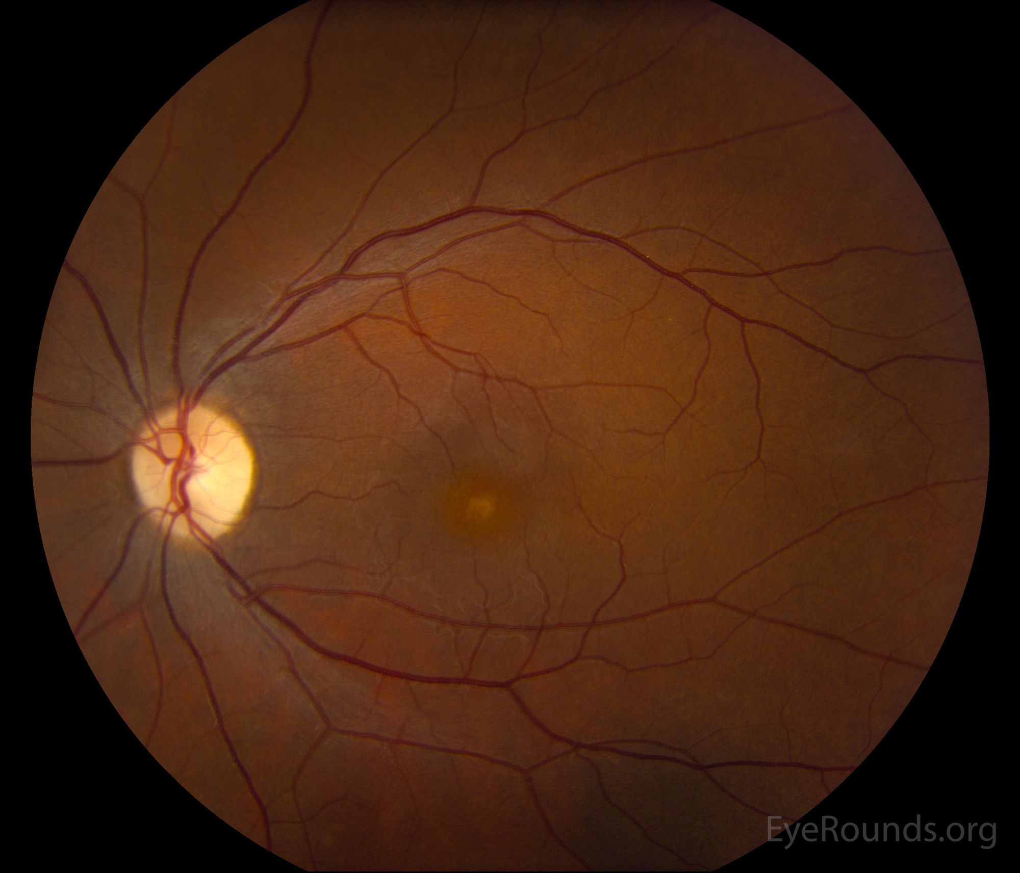 fundus montage OS 42-year-old female with molecularly-proven pattern dystrophy