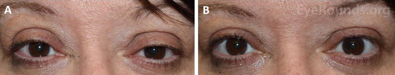 External photographs of a female patient before and after phenylephrine testing. A. Bilateral upper eyelid ptosis is evident prior to phenylephrine testing. B. Elevation of both upper eyelids is demonstrated ten minutes after administration of phenylephrine eye drops in both eyes.