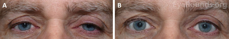 External photographs of a male patient before and after phenylephrine testing. A. Bilateral upper eyelid ptosis is evident prior to phenylephrine testing.  B. Elevation of both upper eyelids is demonstrated ten minutes after administration of phenylephrine eye drops in both eyes.
