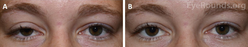 External photographs of a unilateral eyelid ptosis before and after phenylephrine testing.  Photos before (A) and ten minutes after (B) administration of phenylephrine eye drops in the right eye only demonstrate the marked elevation of the right eyelid above the pupillary light reflex after drop administration. 