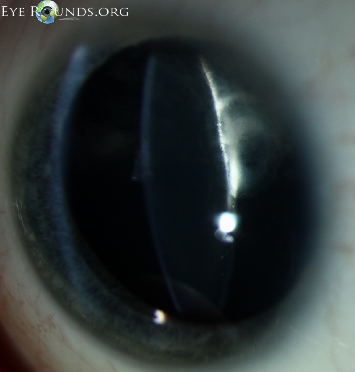 bilateral Posterior polar cataracts upclose