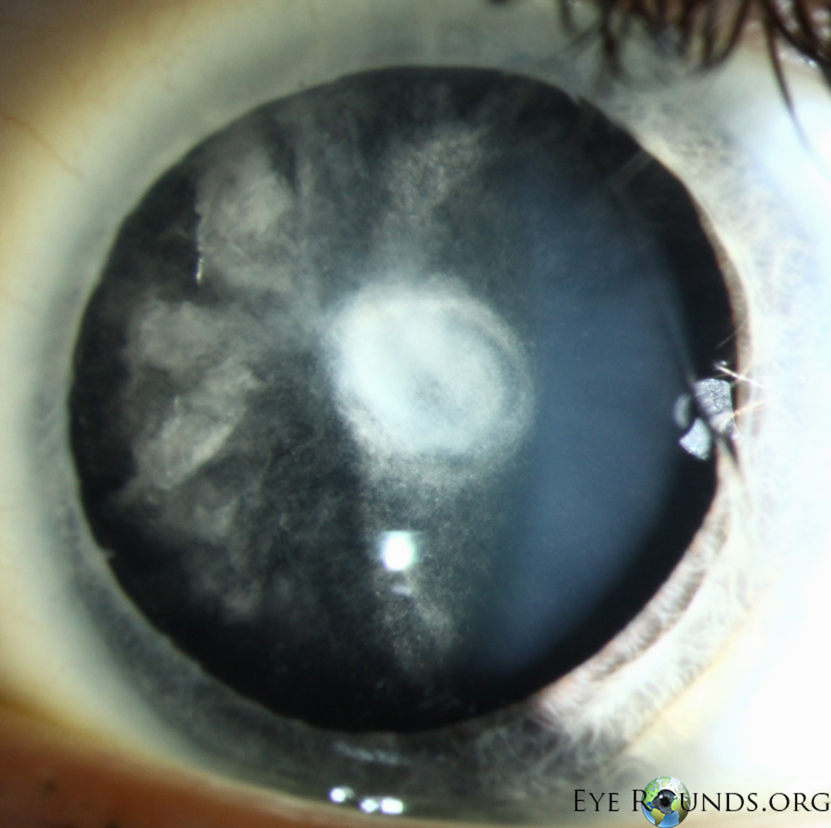 bilateral Posterior polar cataracts upclose 4