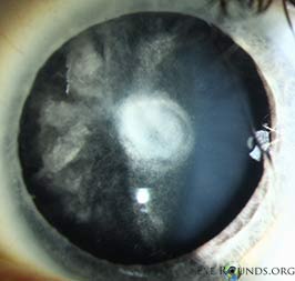 posterior polar cataracts