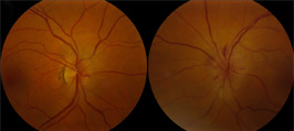 Pseudo-Foster Kennedy Syndrome