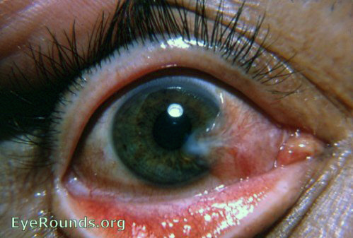 pterygium: a prototypical example