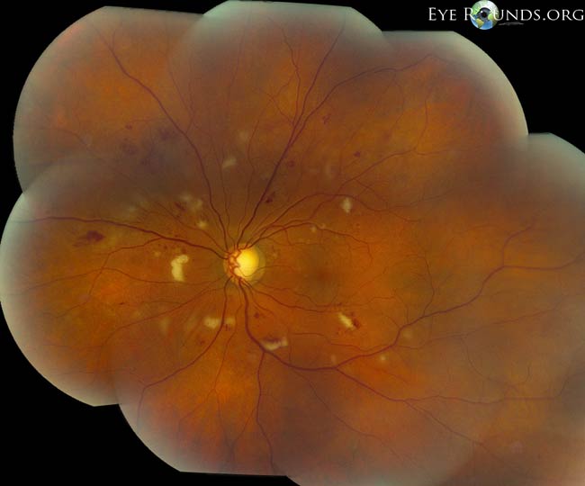fundus showing microaneurysms, retinal hemorrhages, exudates, and cotton wool spots as seen in this photograph