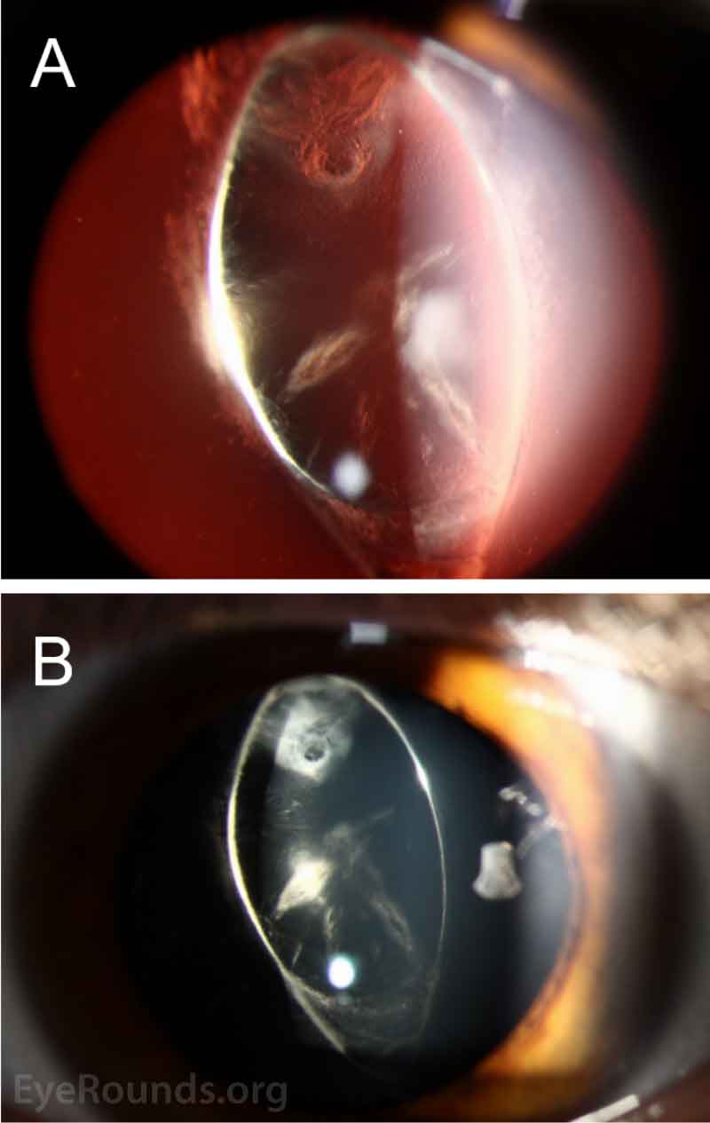 slit lamp exam of traumatic cataract with large longitudinal rupture of the posterior capsule