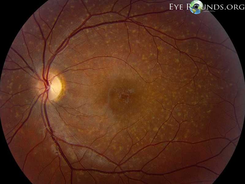 Stargardt Disease Light Eye