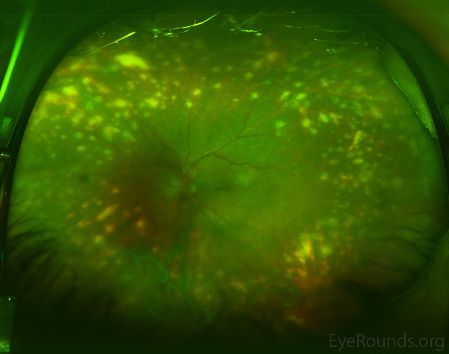  Optos ultra-widefield pseudocolor fundus photography